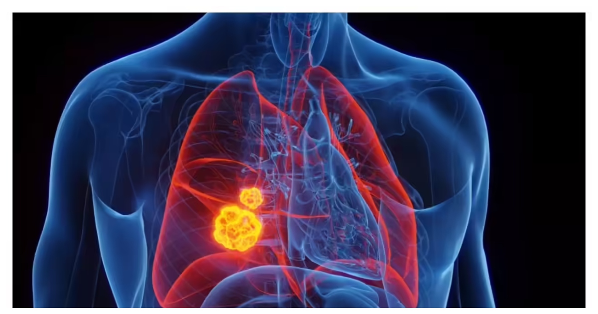 ছোট ভুলের কারণে ৬০ শতাংশ ক্ষেত্রে স্টেজ ৪-এ গিয়ে ফুসফুসের ক্যান্সার ধরা পড়ে। ছবি: টাইমস অফ ইন্ডিয়া